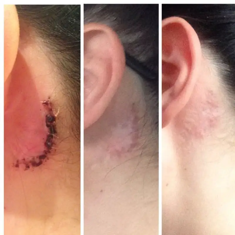 After Surgical Tattoo Removal with a Scar