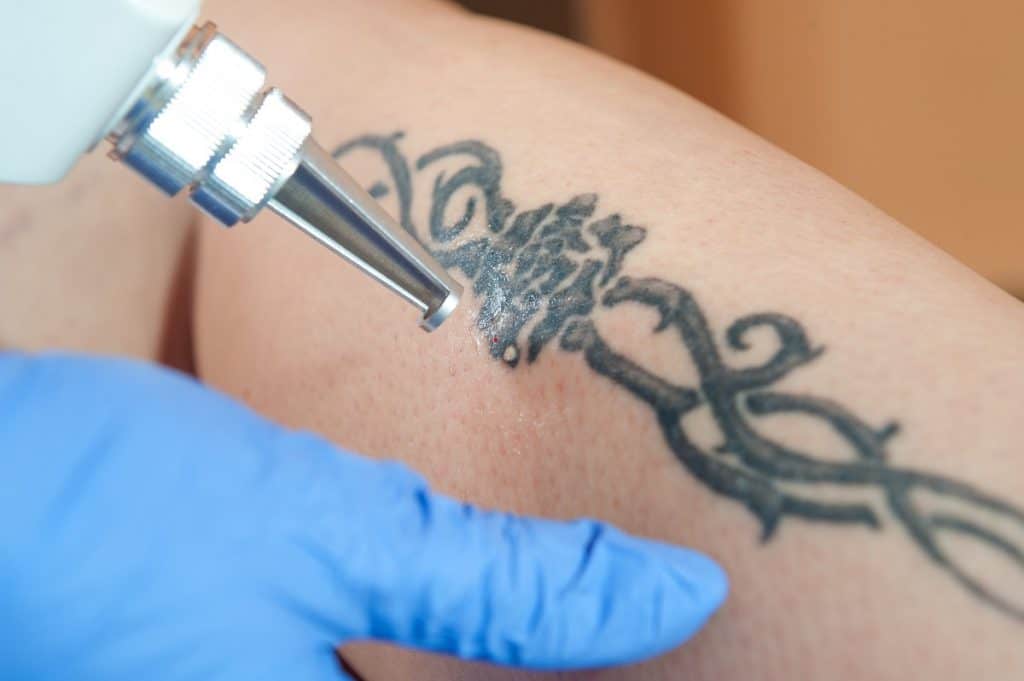 Is Laser Tattoo Removal Expensive