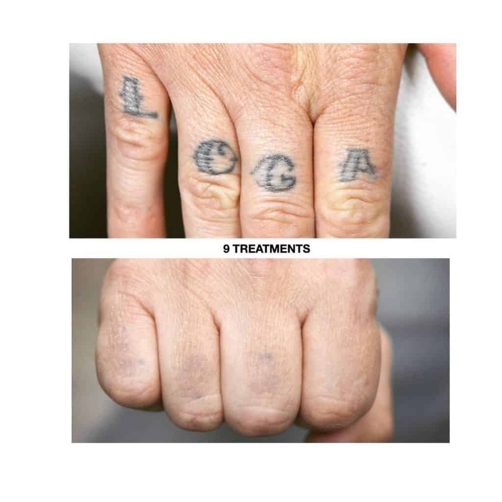 And Why Natural Tattoo Removal is EVEN WORSE!