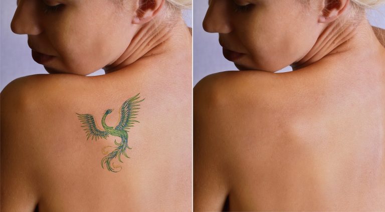 The Easiest and Hardest Tattoo Pigments To Remove